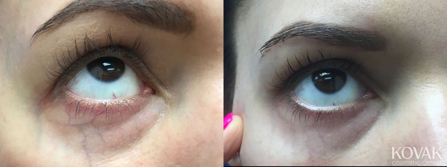 Before and after Eye Vein Treatment case 36572