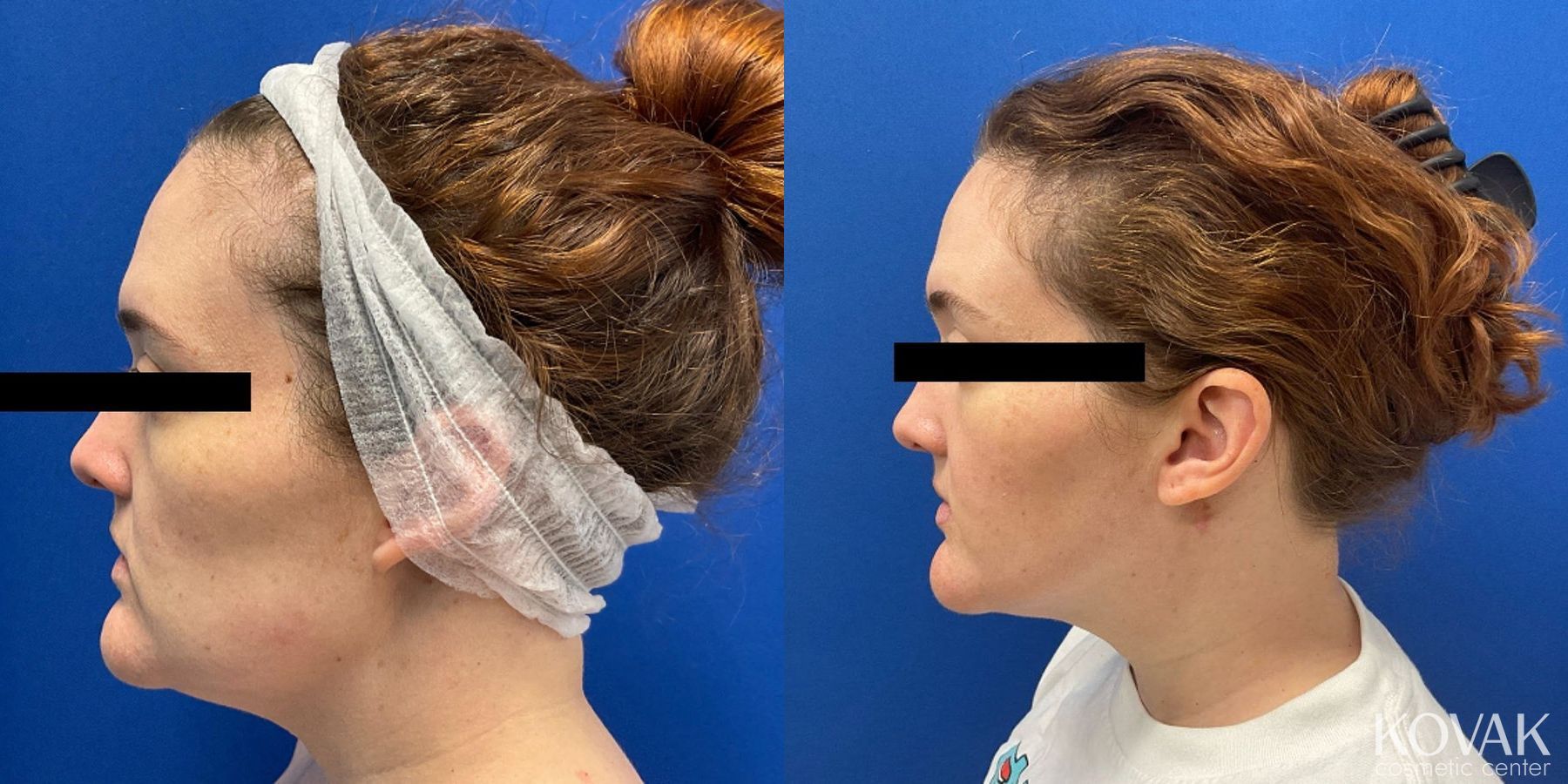 Before and after VLR - Vaser Laser - Jawline Sculpting case 36776