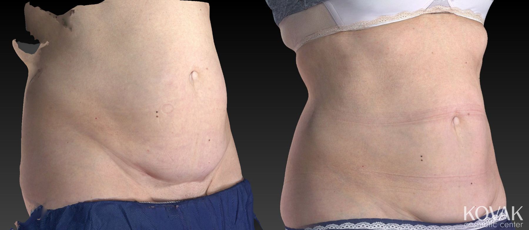 Before and after CoolSculpting® case 36564 - Angle 3