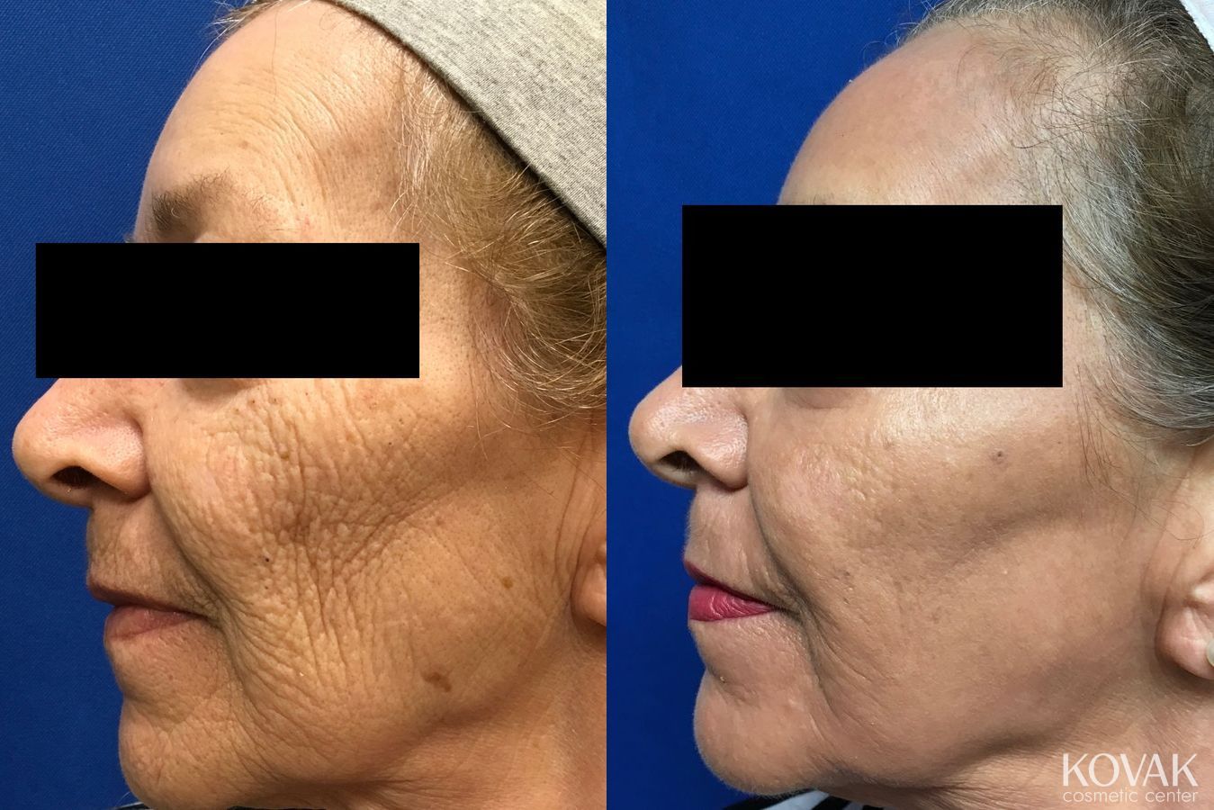 Before and after Laser Skin Resurfacing - Face case 36624 - Angle 2