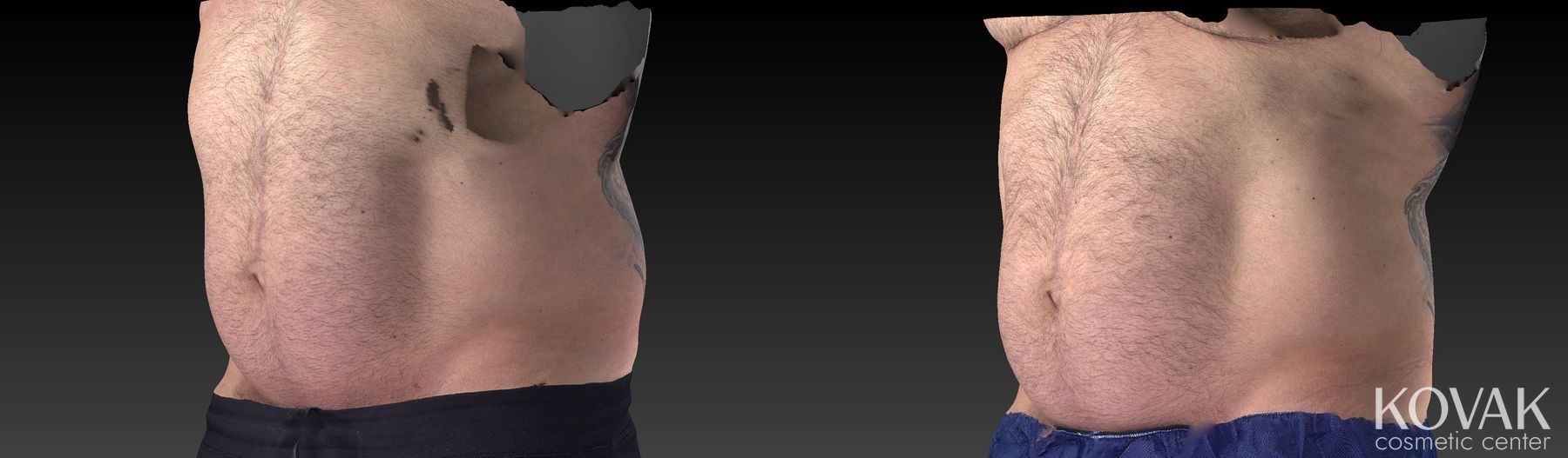Before and after CoolSculpting® case 36562 - Angle 4