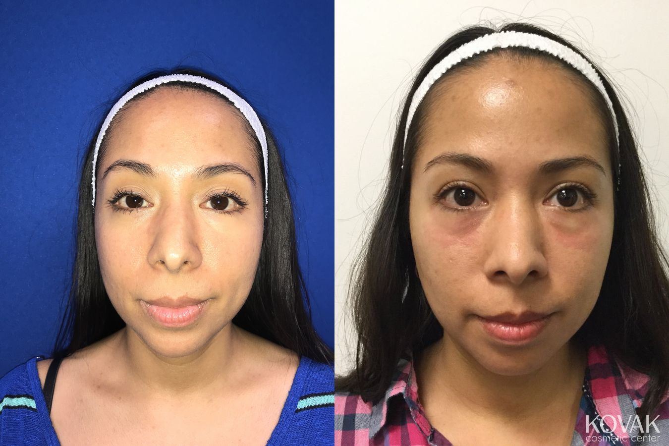 Before and after Restylane® case 36590