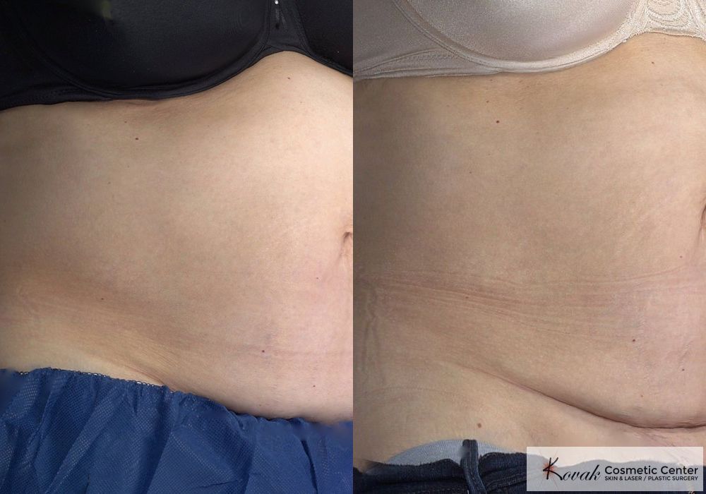 CoolSculpting® - Thumbnail 2