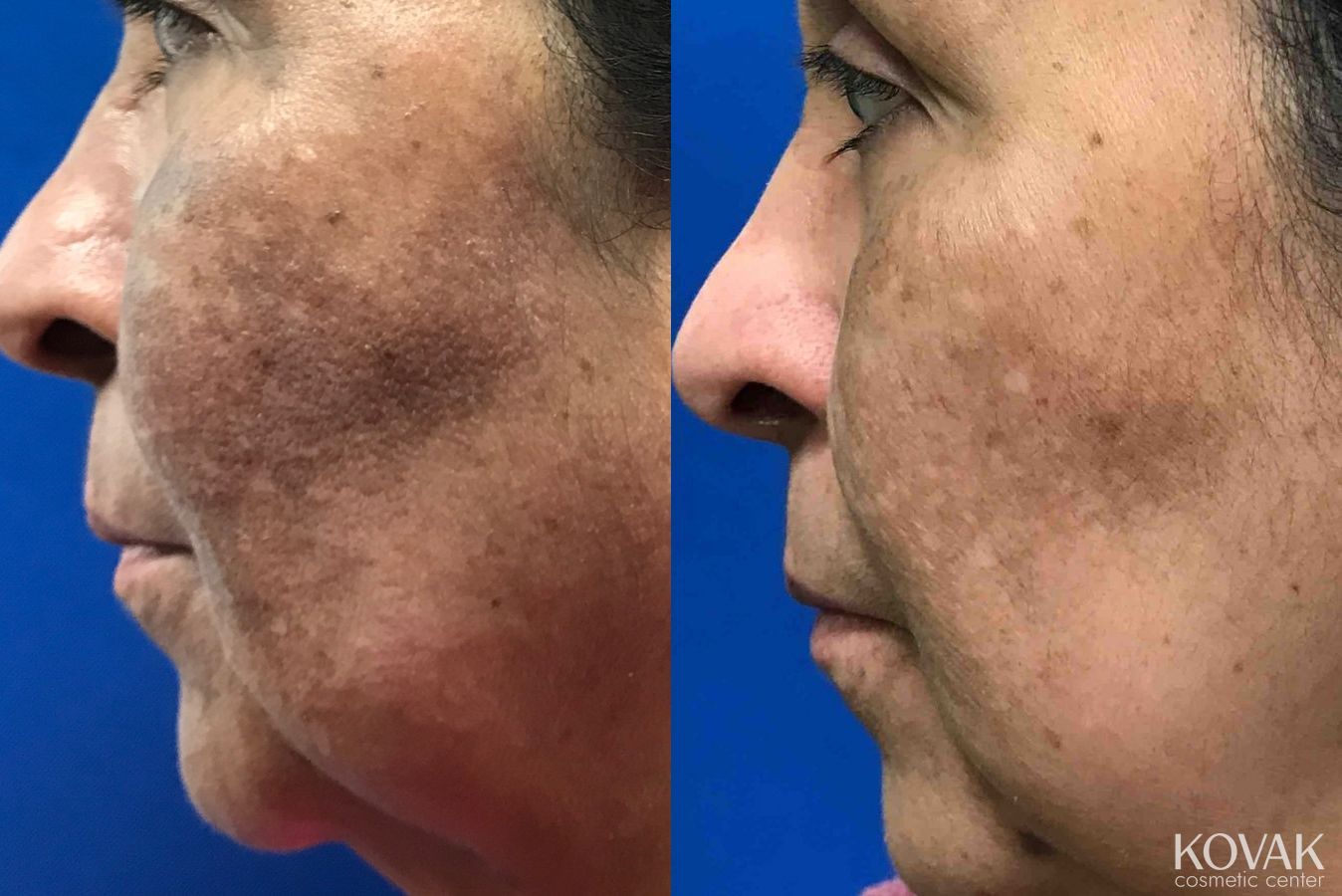 Before and after Melasma case 36615