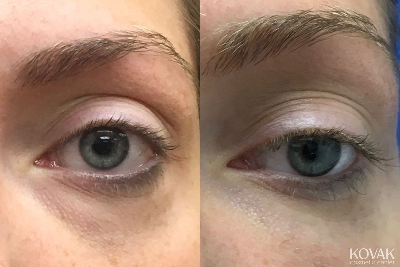 Before and after Eye Treatments case 36601 - Angle 2