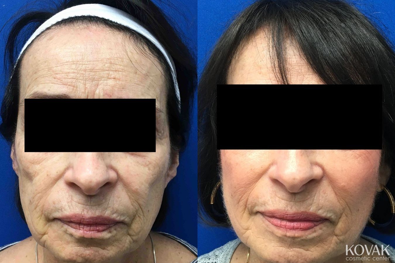 Before and after Facial Volume case 36677