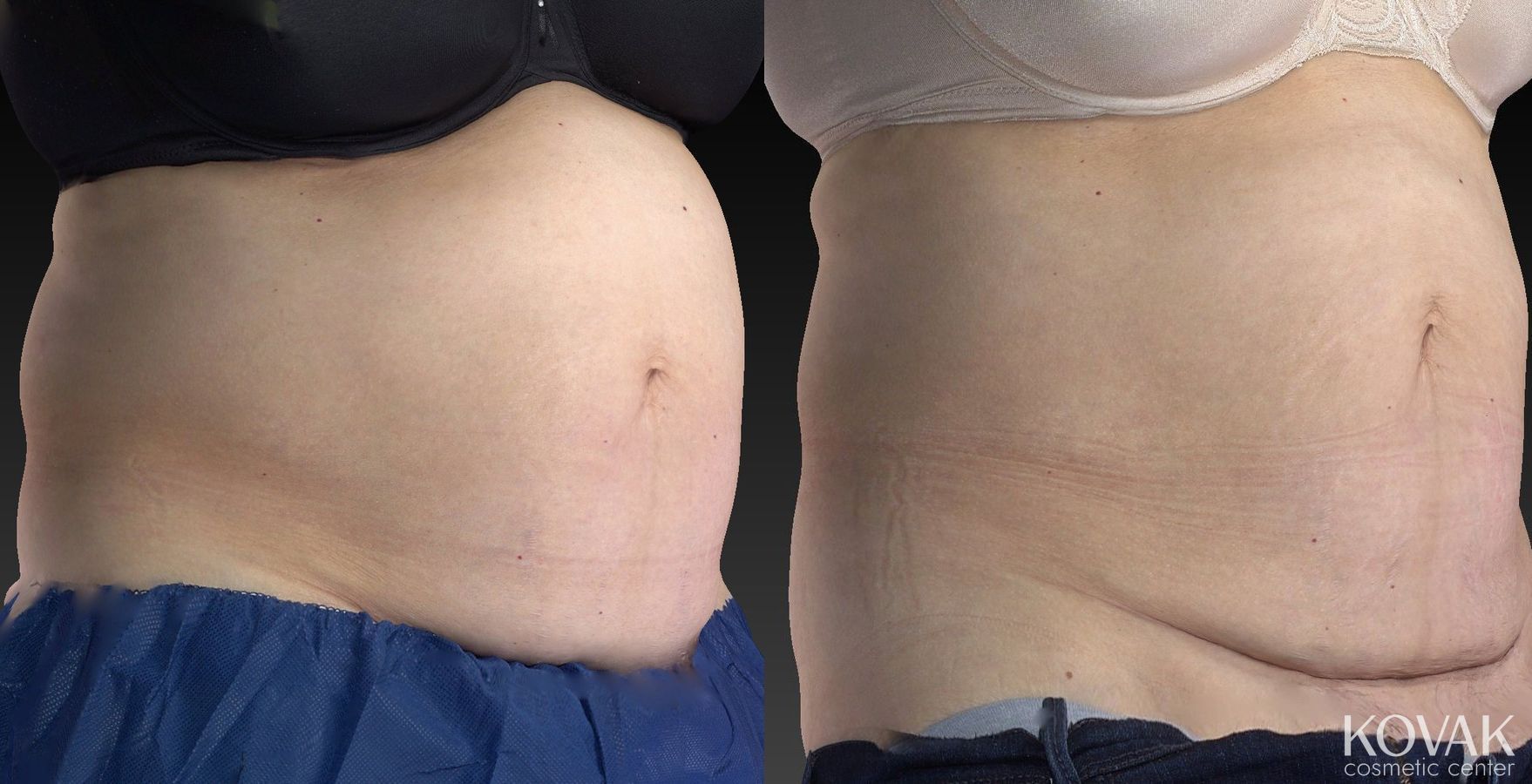 Before and after CoolSculpting® case 36480 - Angle 2