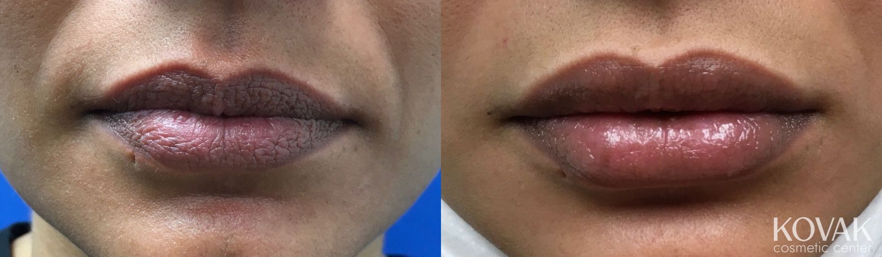 Before and after Lips - Plump / Filled case 36676