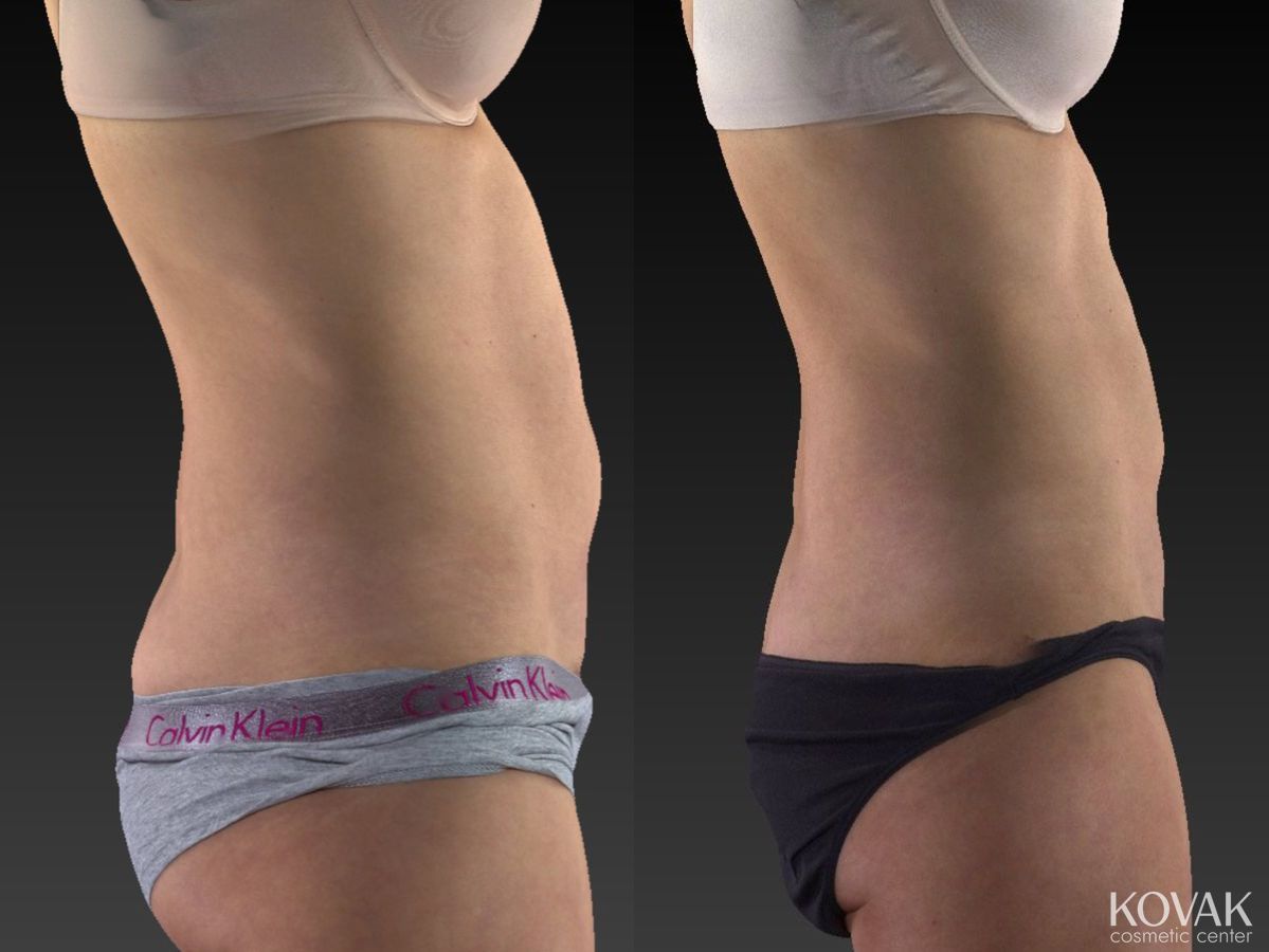 Before and after CoolSculpting® case 36580 - Angle 3