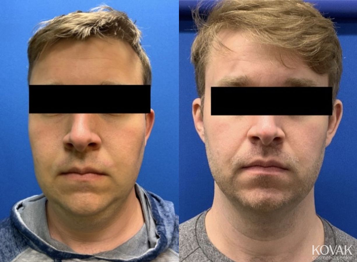Before and after VLR - Vaser Laser - Jawline Sculpting case 36766 - Angle 3