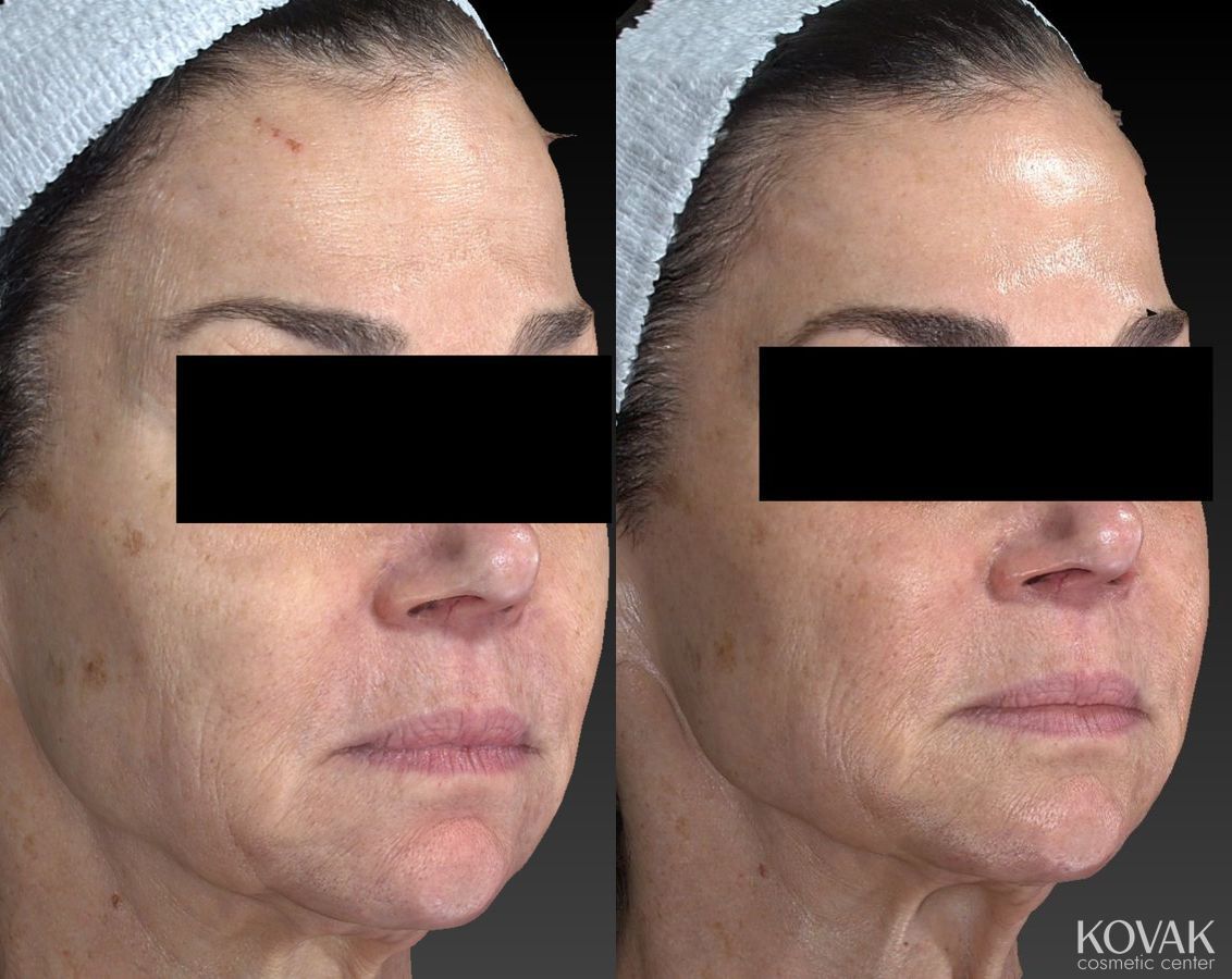 Before and after Halo™ case 36585 - Angle 5