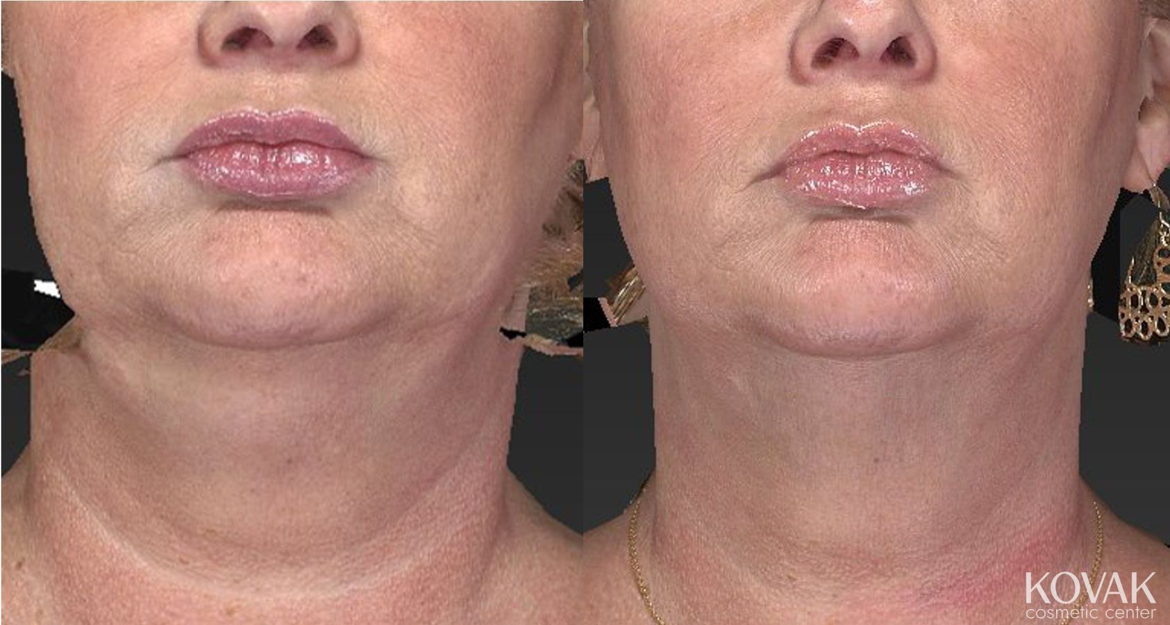Before and after Kybella case 36478