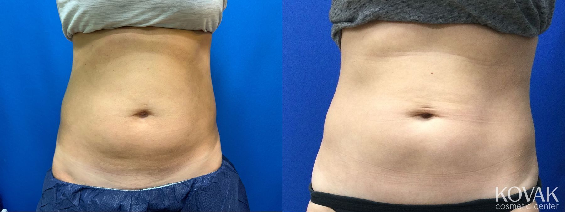 Before and after CoolSculpting® case 36726 - Angle 3