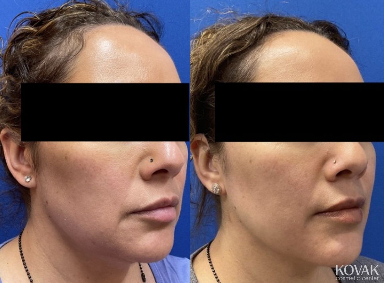 Before and after VLR - Vaser Laser - Jawline Sculpting case 36763 - Angle 2