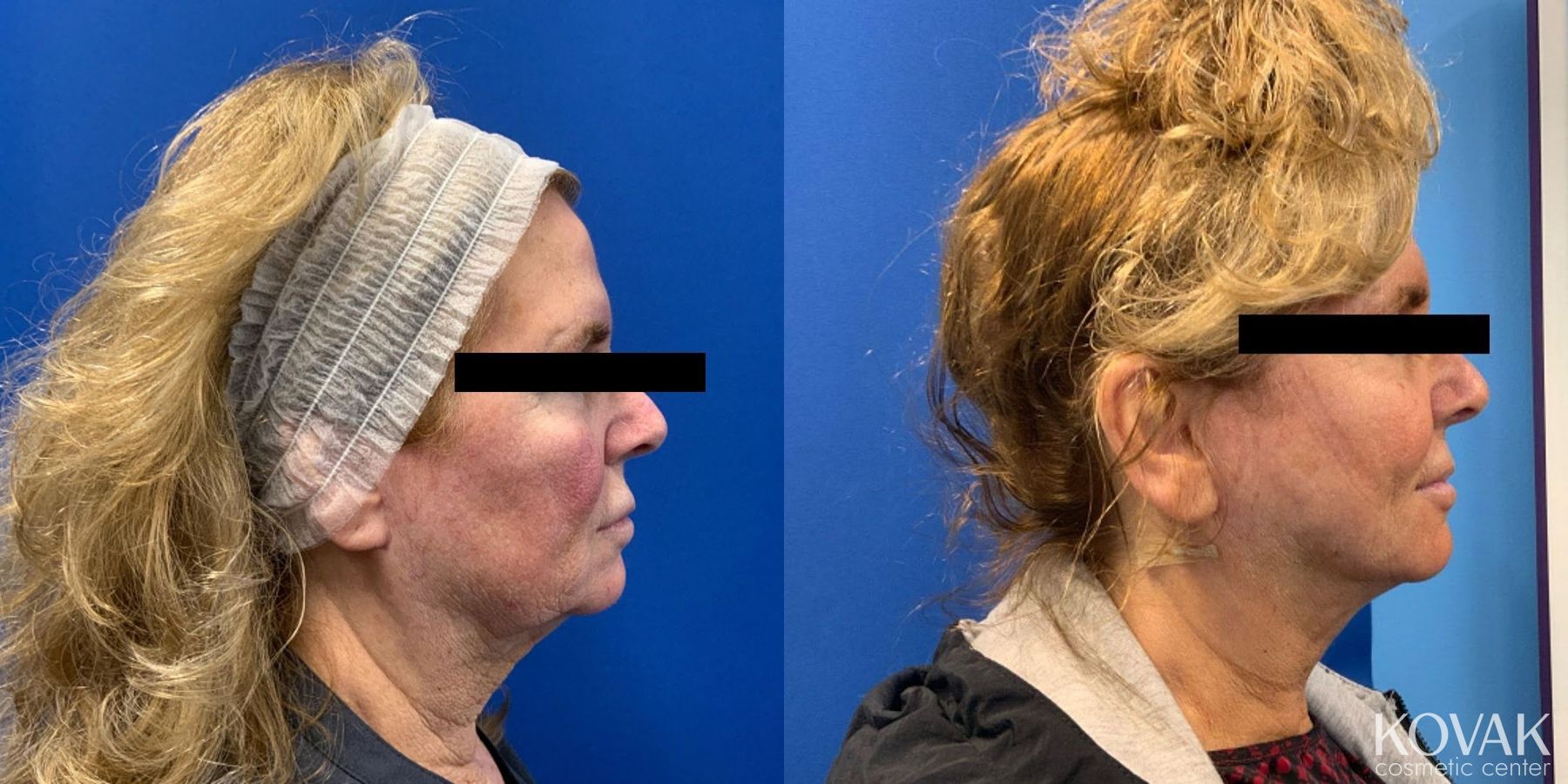Before and after VLR - Vaser Laser - Jawline Sculpting case 36769