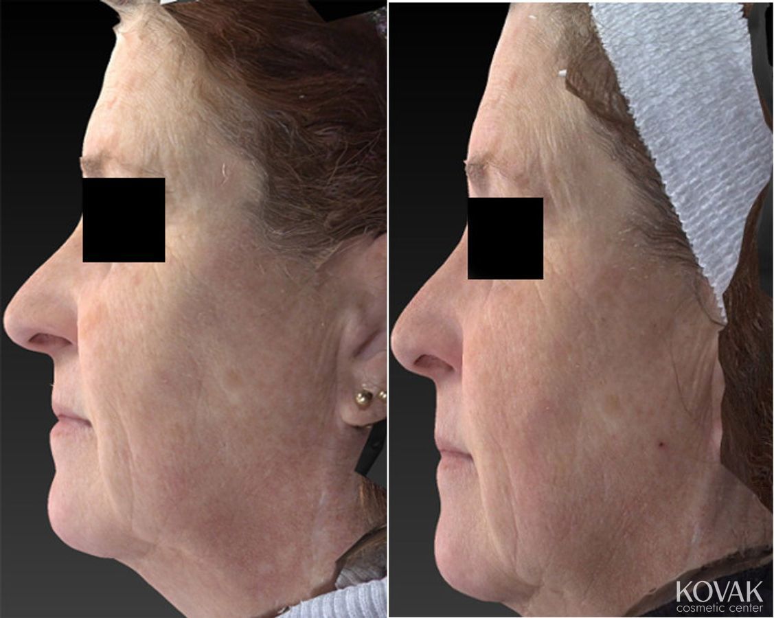 Before and after Halo™ case 36473 - Angle 2
