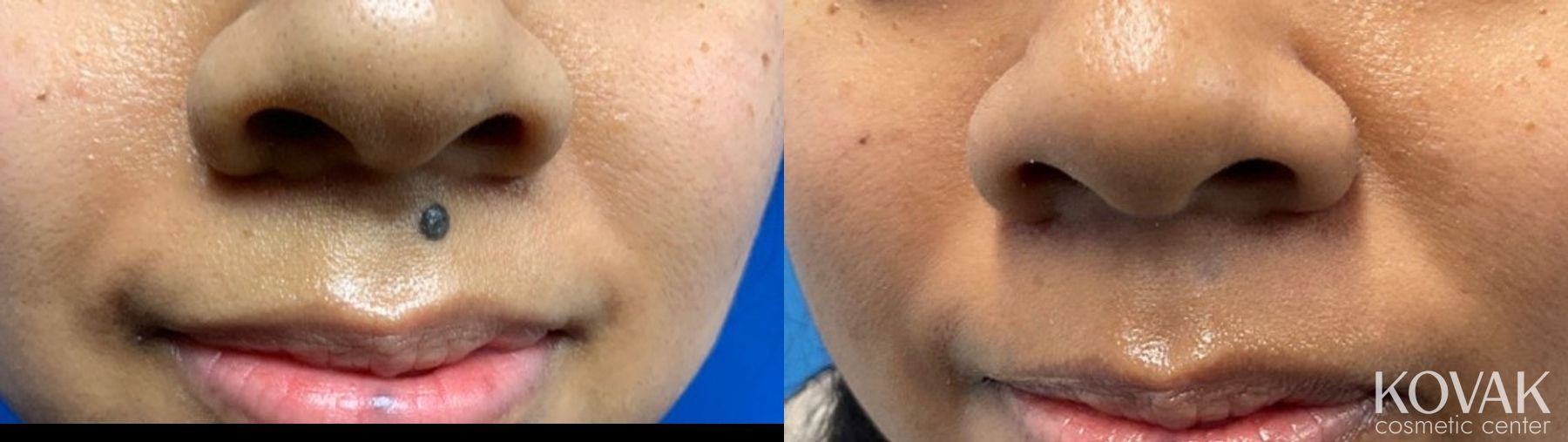 Before and after Mole Removal case 36727