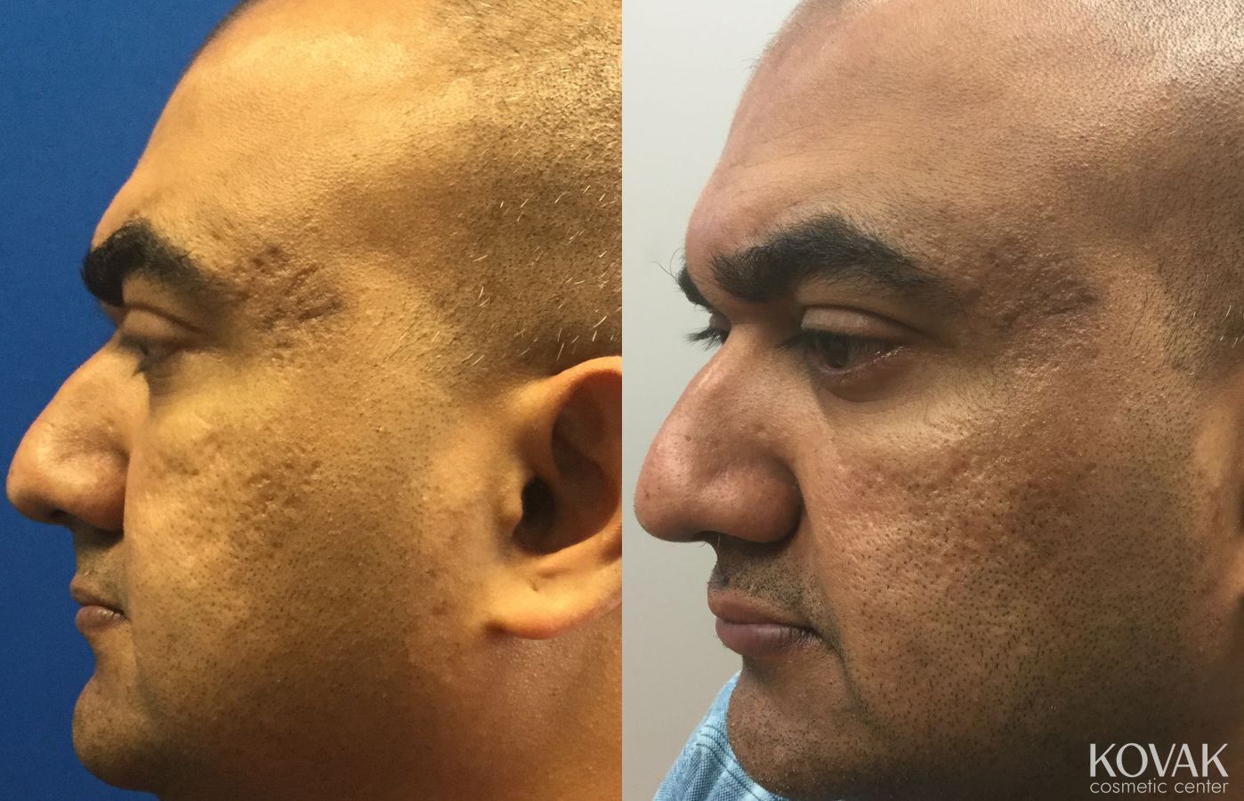 Before and after Juvéderm® XC case 36565 - Angle 3