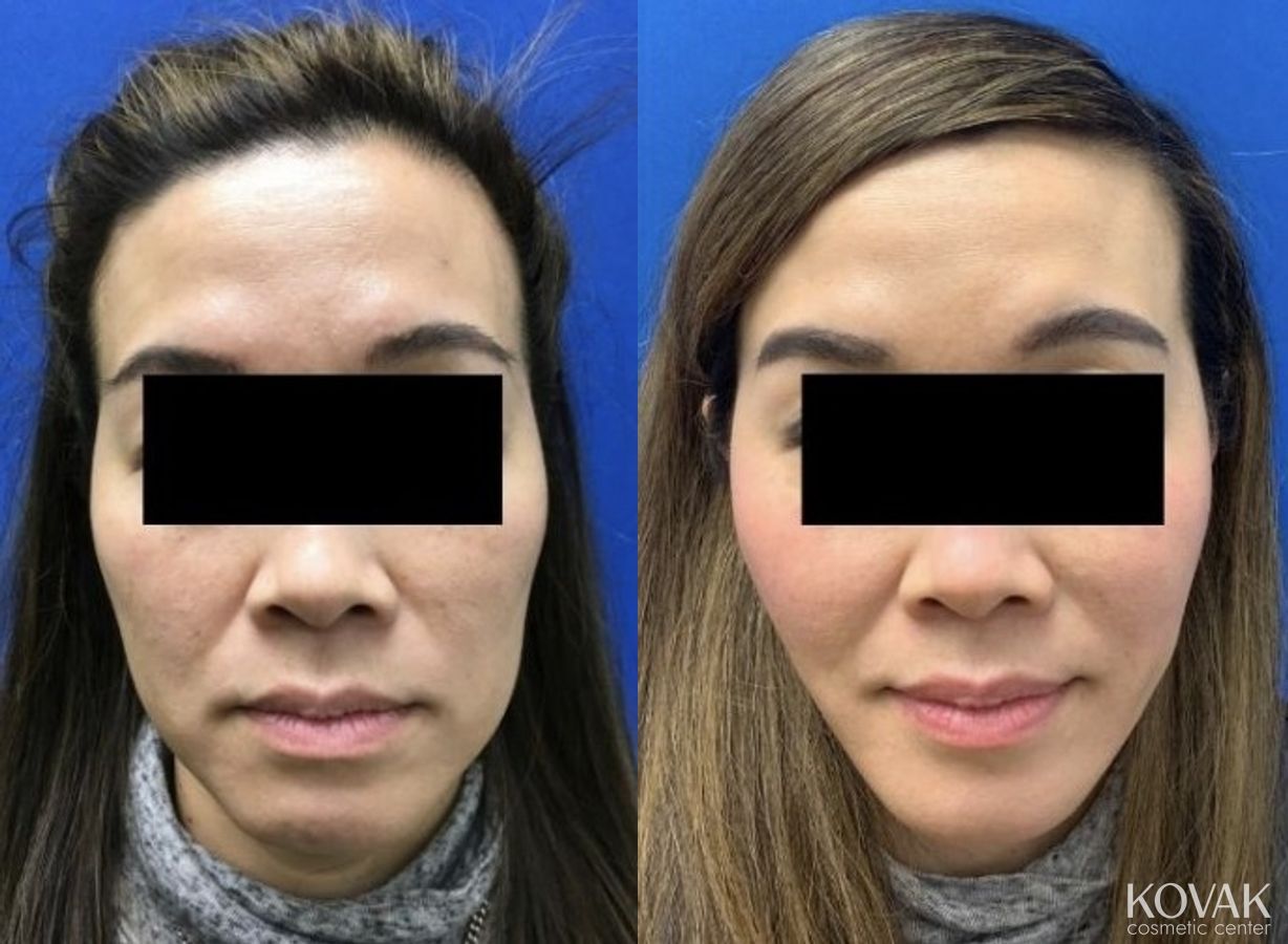Before and after VLR - Vaser Laser - Jawline Sculpting case 36748