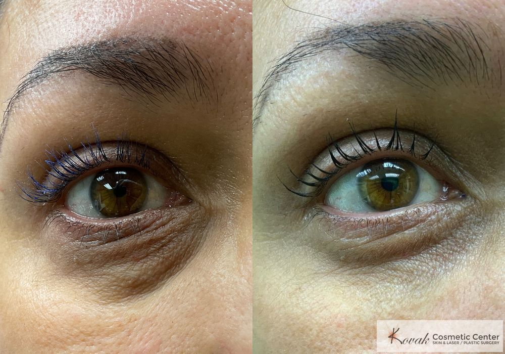 Eye Treatments - Case 1484