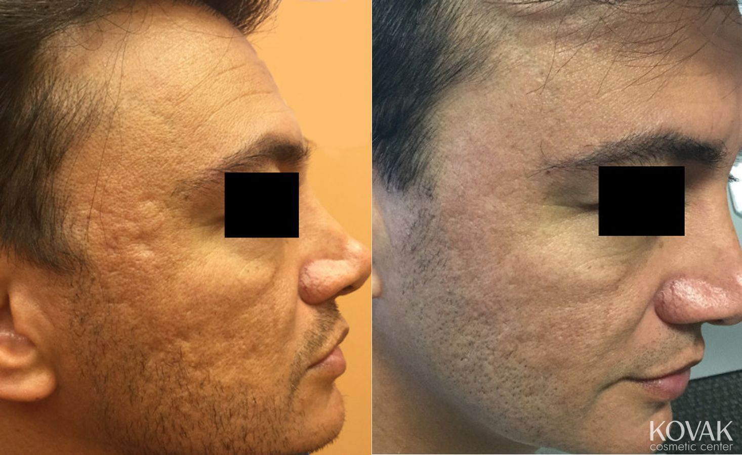 Before and after Juvéderm® XC case 36609 - Angle 2