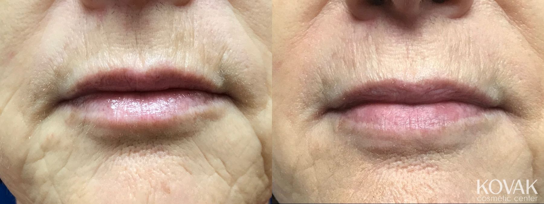 Before and after Lips - Fine Lines case 36448
