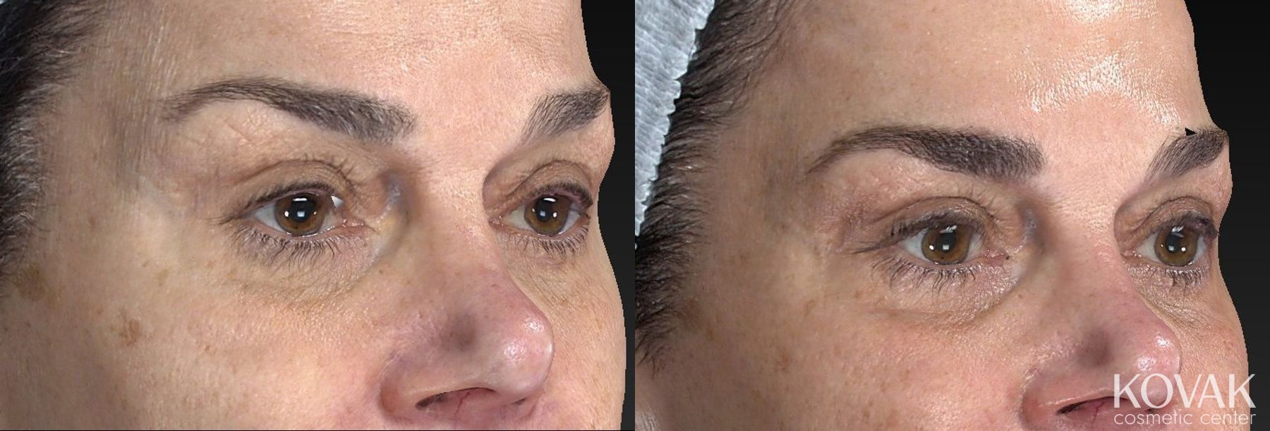 Before and after Laser Skin Resurfacing - Face case 36594 - Angle 5