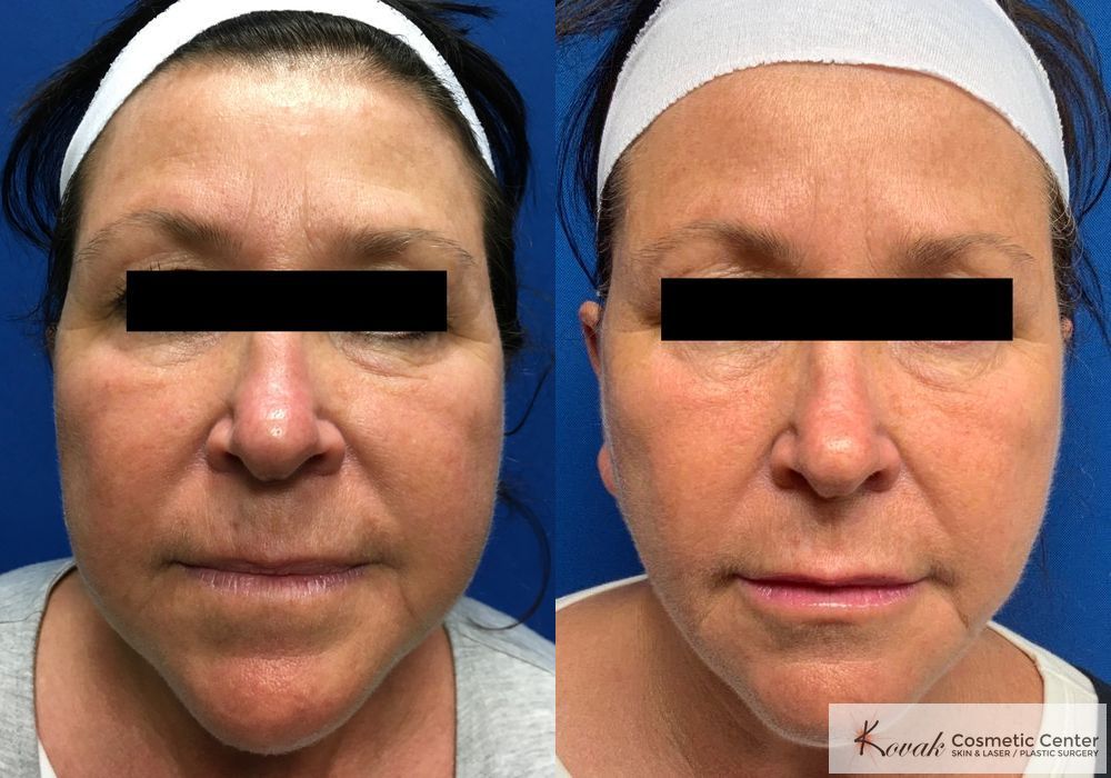 Laser Liposuction - Case 1464