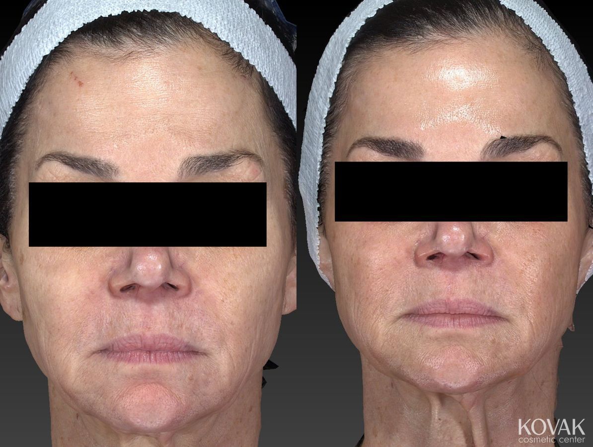 Before and after Halo™ case 36585 - Angle 4