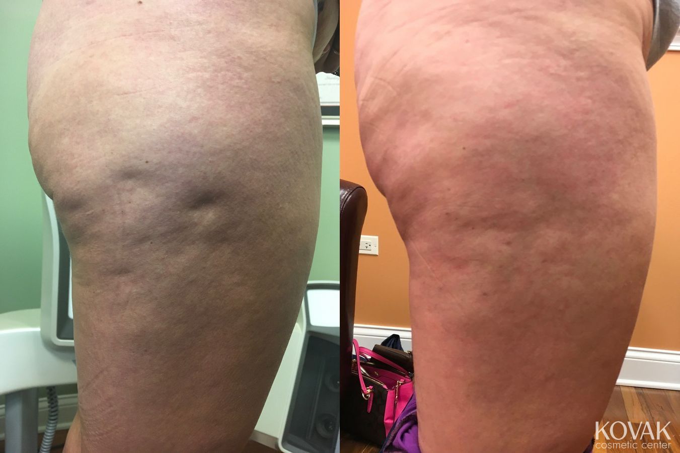 Before and after Cellulite Reduction case 36526 - Angle 3