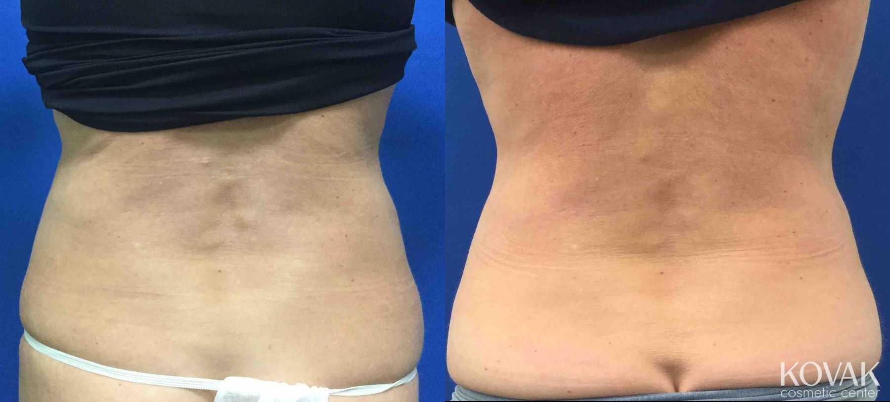 Before and after EMSCULPTĀ® case 36684 - Angle 4