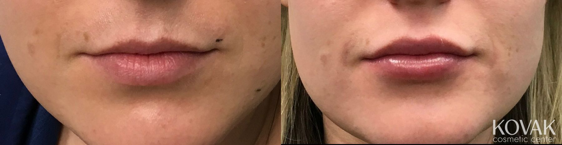 Before and after Juvéderm® XC case 36472