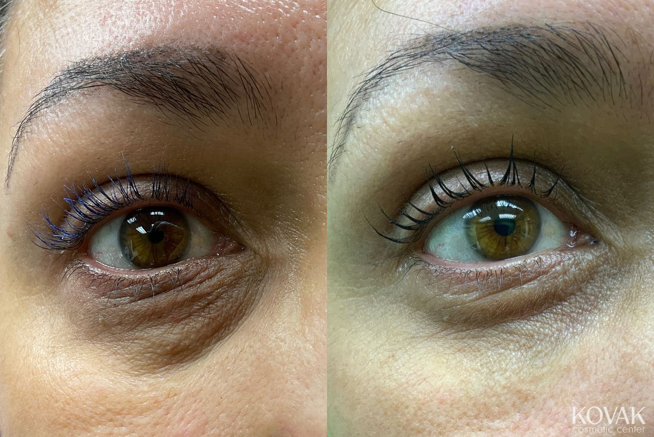 Before and after Eye Treatments case 36711