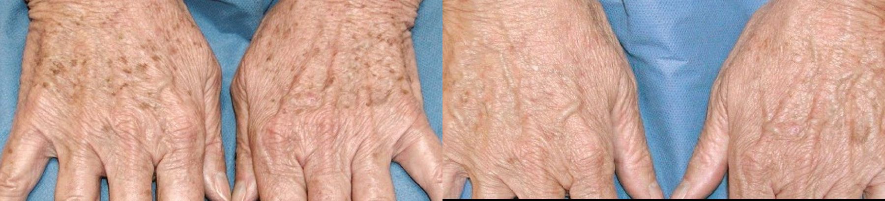 Before and after Tyte and Bryte Photorejuvenation case 36695