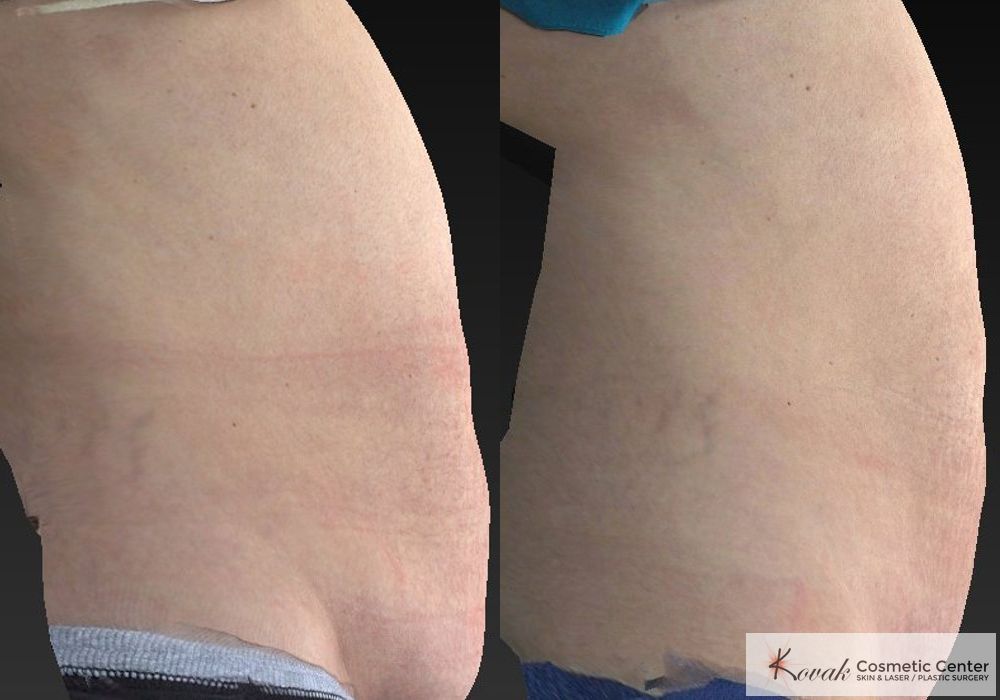 CoolSculpting® - Thumbnail 3