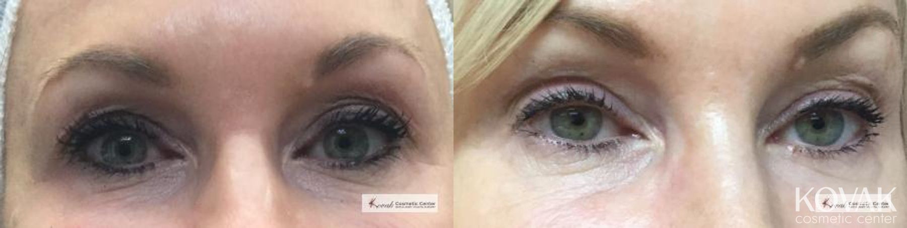 Before and after ThermiSmooth® case 36533