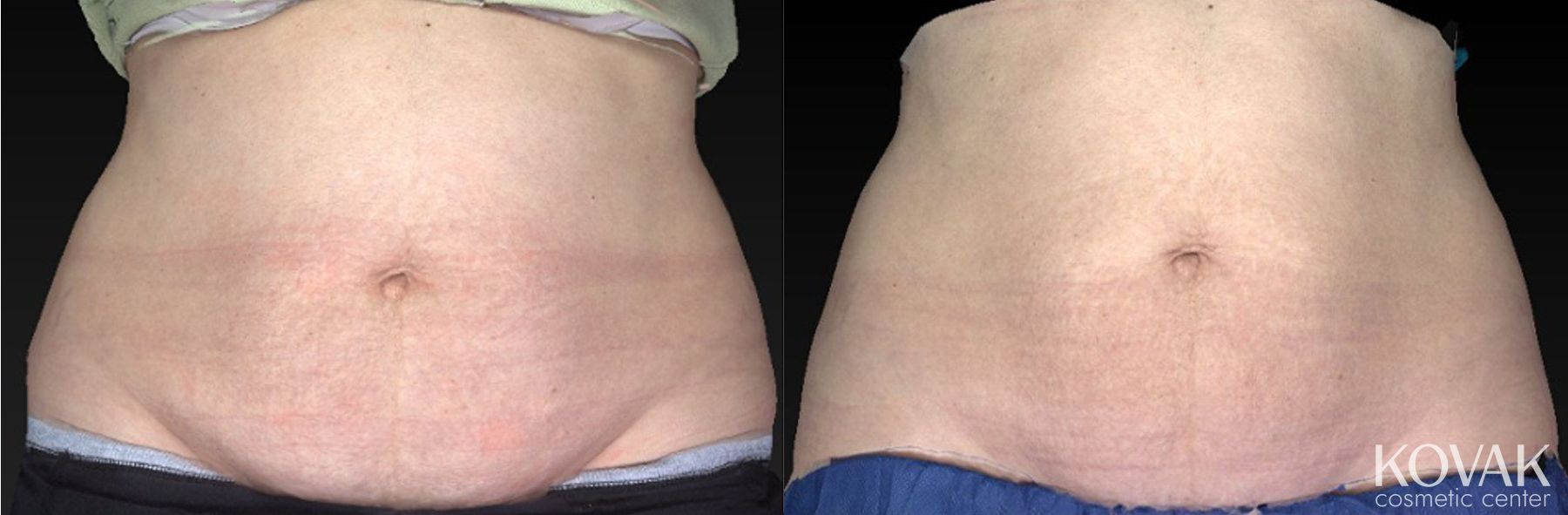 Before and after CoolSculpting® case 36459