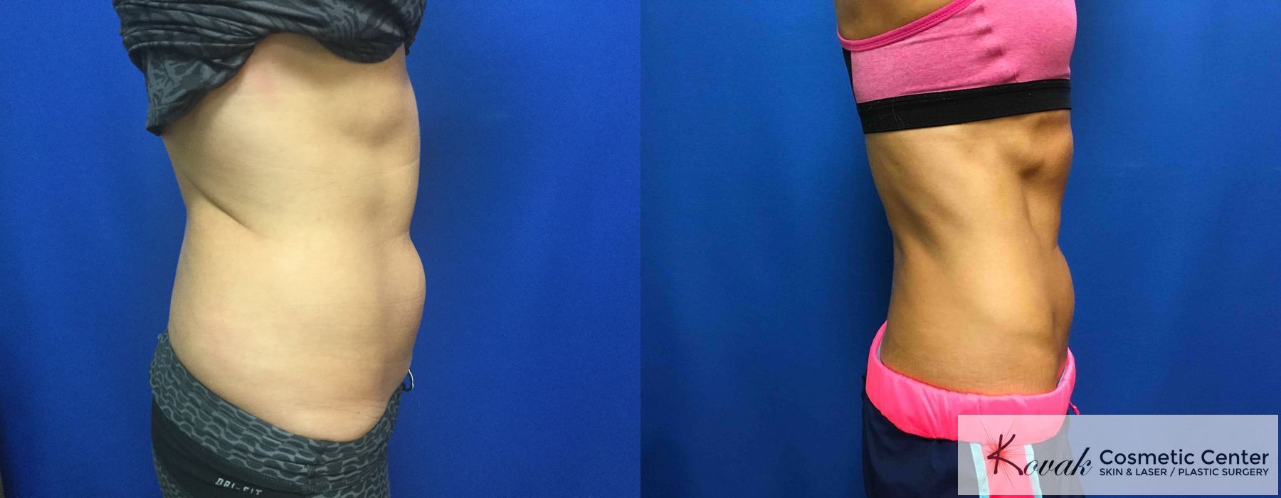 CoolSculpting® - Thumbnail 3