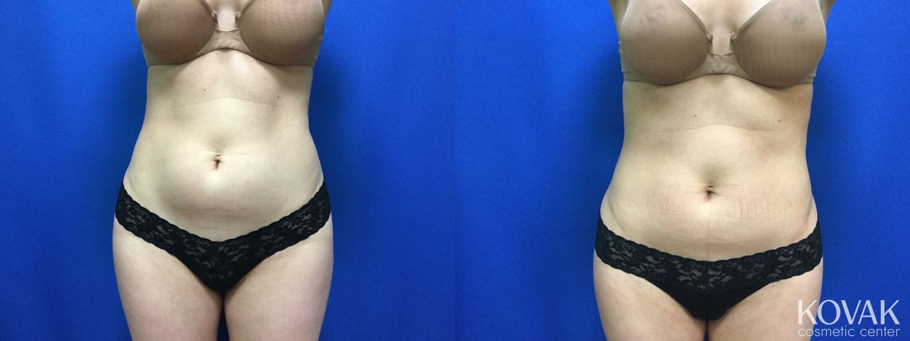 Before and after CoolSculpting® case 36543