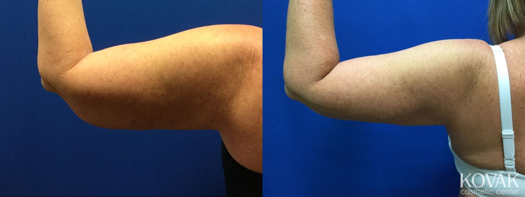 Before and after Laser Liposuction case 36541 - Angle 2