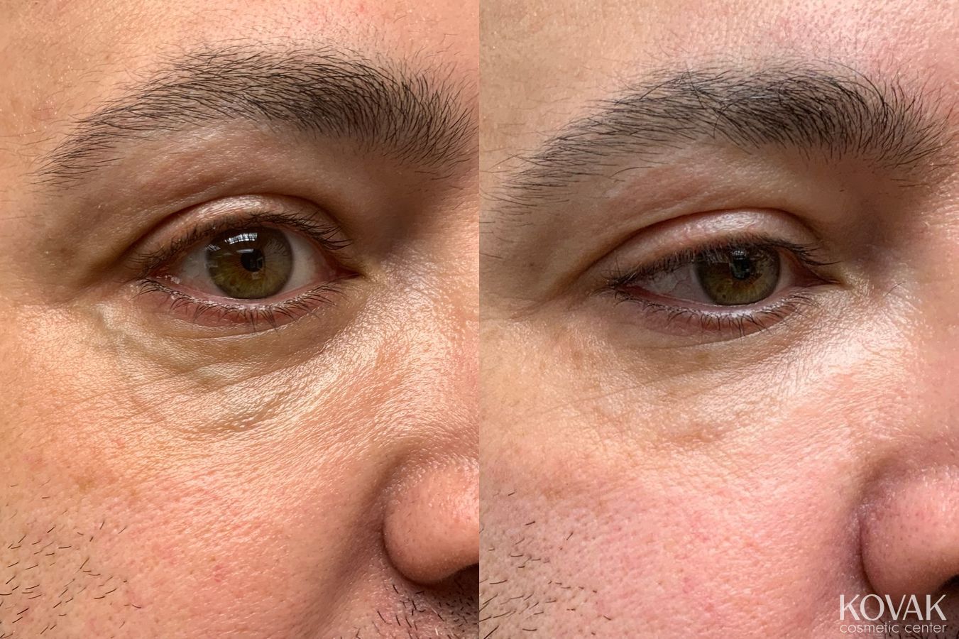 Before and after Eye Vein Treatment case 36744