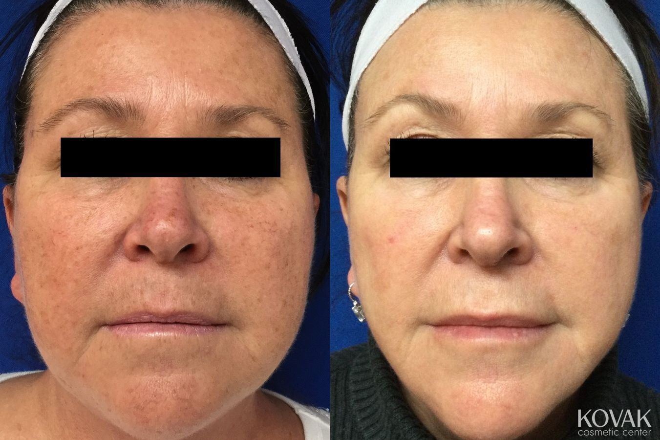 Before and after Tyte and Bryte Photorejuvenation case 36745
