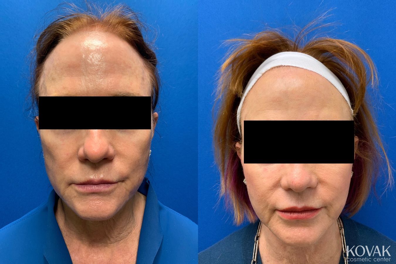 Before and after Facial Volume case 36716