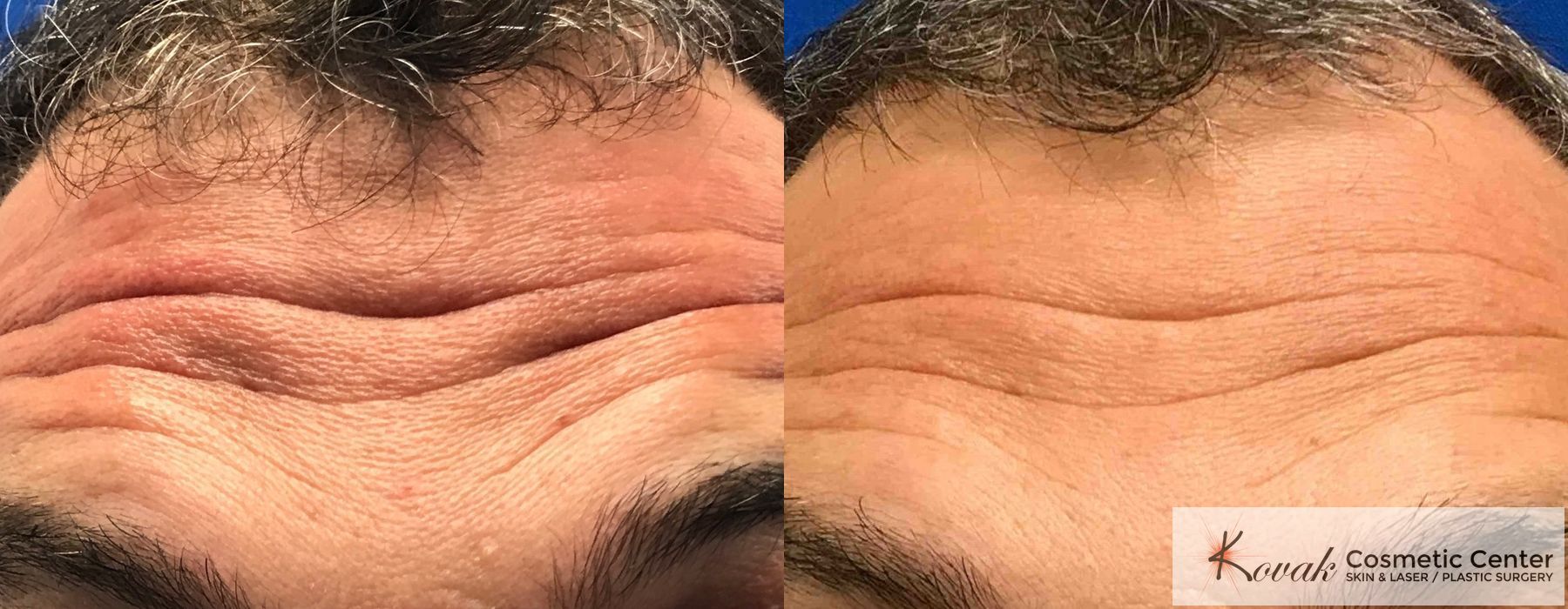 Forehead Lines - Case 1515