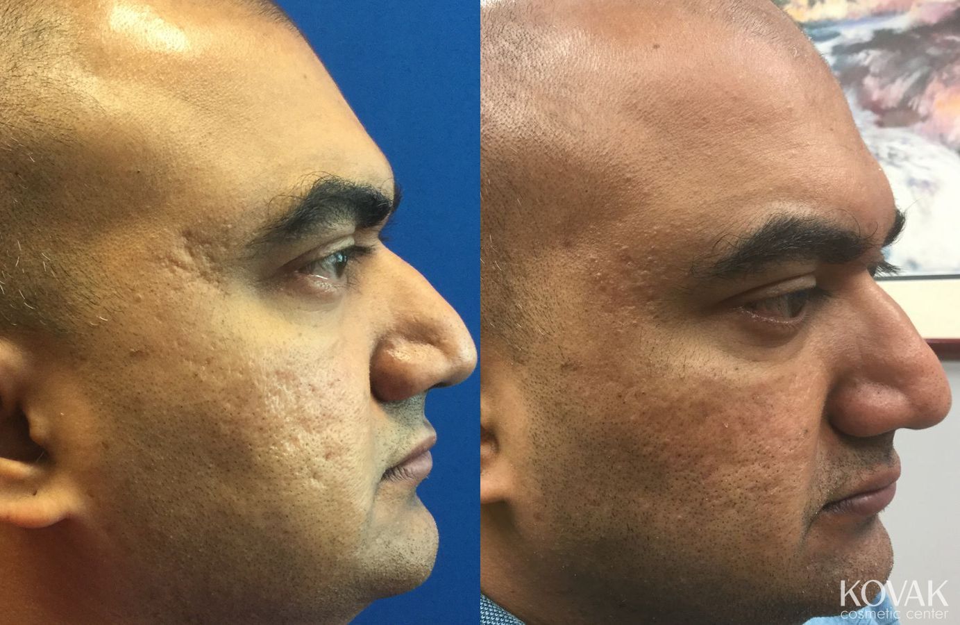 Before and after Juvéderm® XC case 36565 - Angle 2