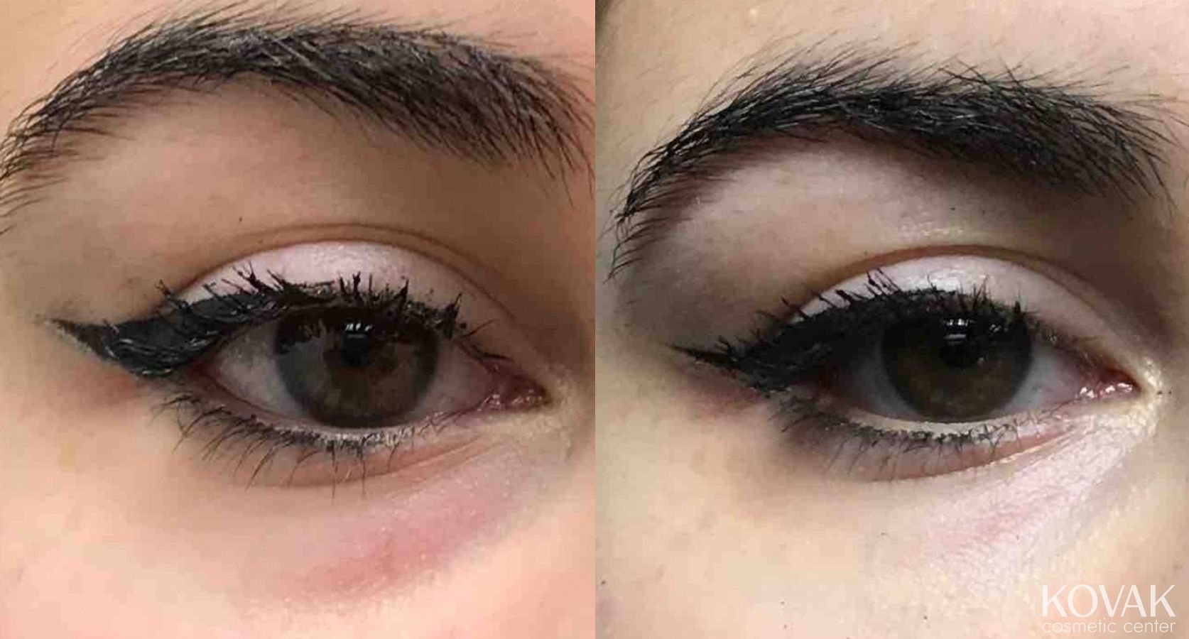 Before and after Eye Treatments case 36457