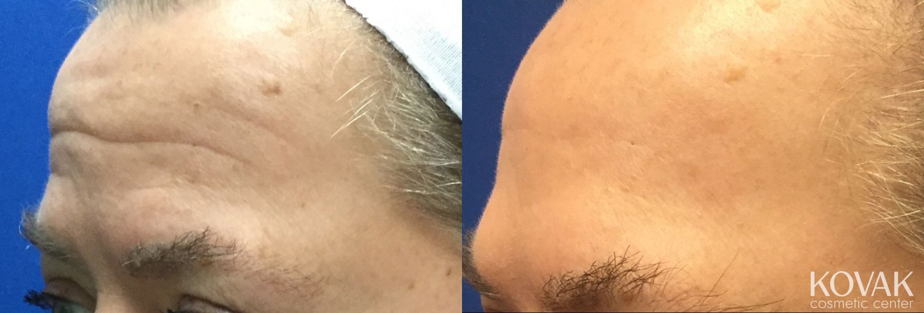 Before and after BOTOX® Cosmetic case 36643 - Angle 2