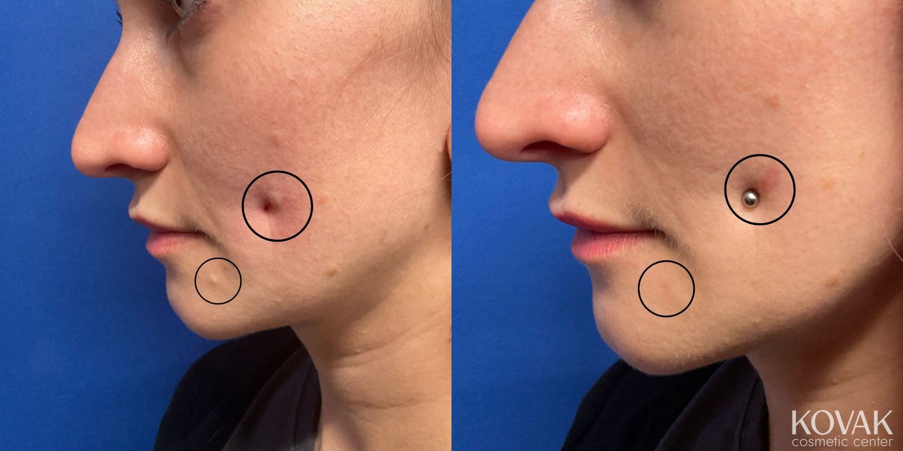 Before and after Mole Removal case 36758