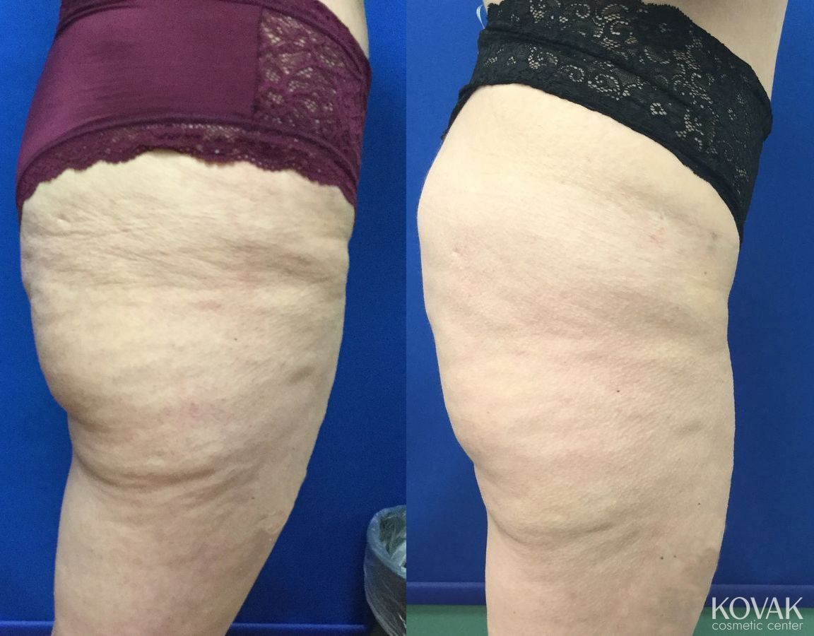 Before and after EMSCULPTĀ® case 36685 - Angle 3