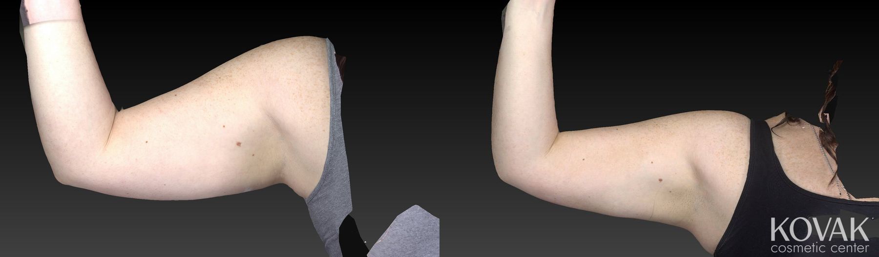 Before and after CoolSculpting® case 36593 - Angle 4